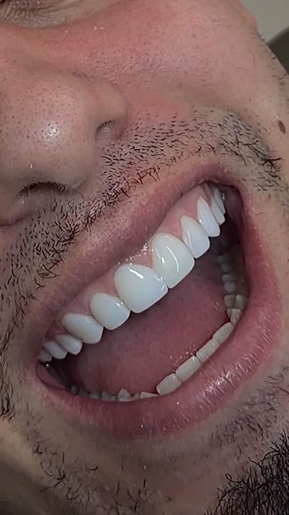 Resultado de lentes em resina — sorriso natural