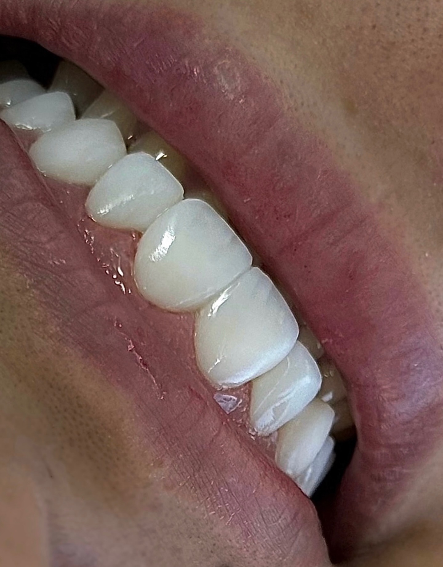 Detalhe de dentes com resultado natural