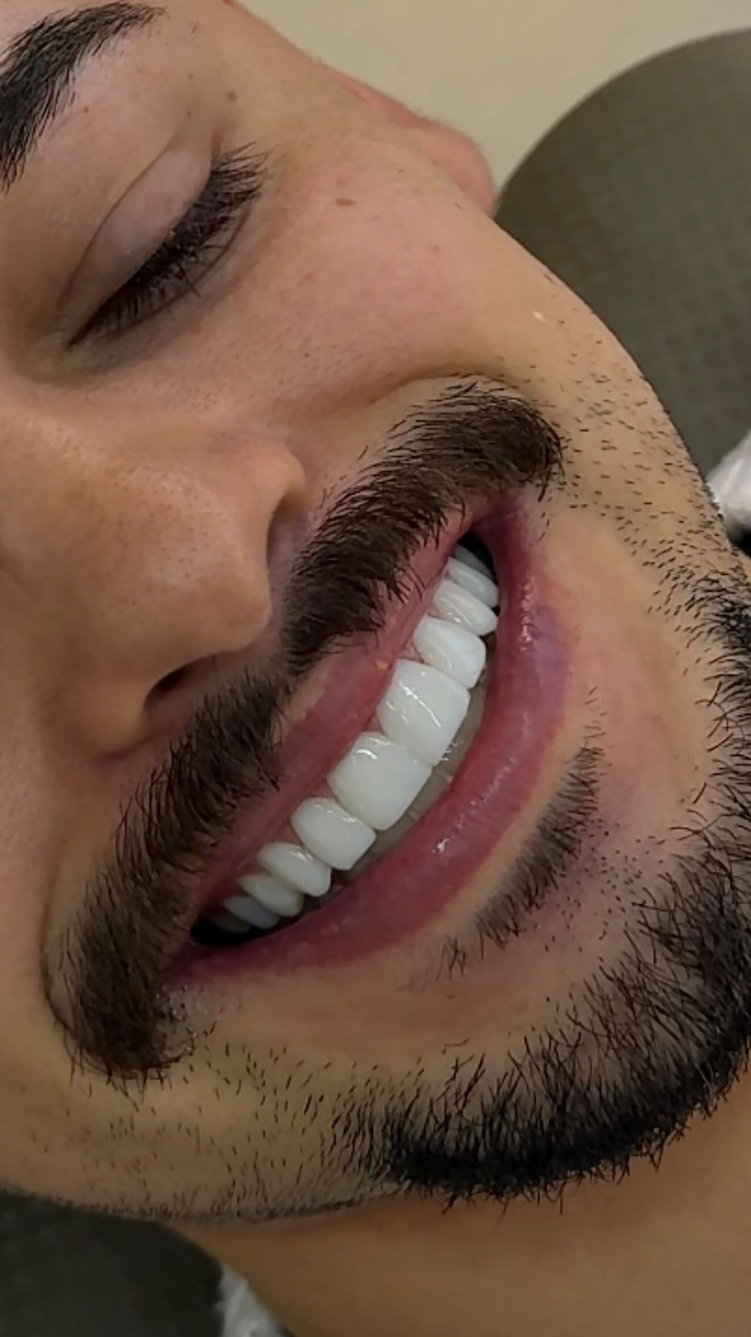 Sorriso transformado com lentes em resina