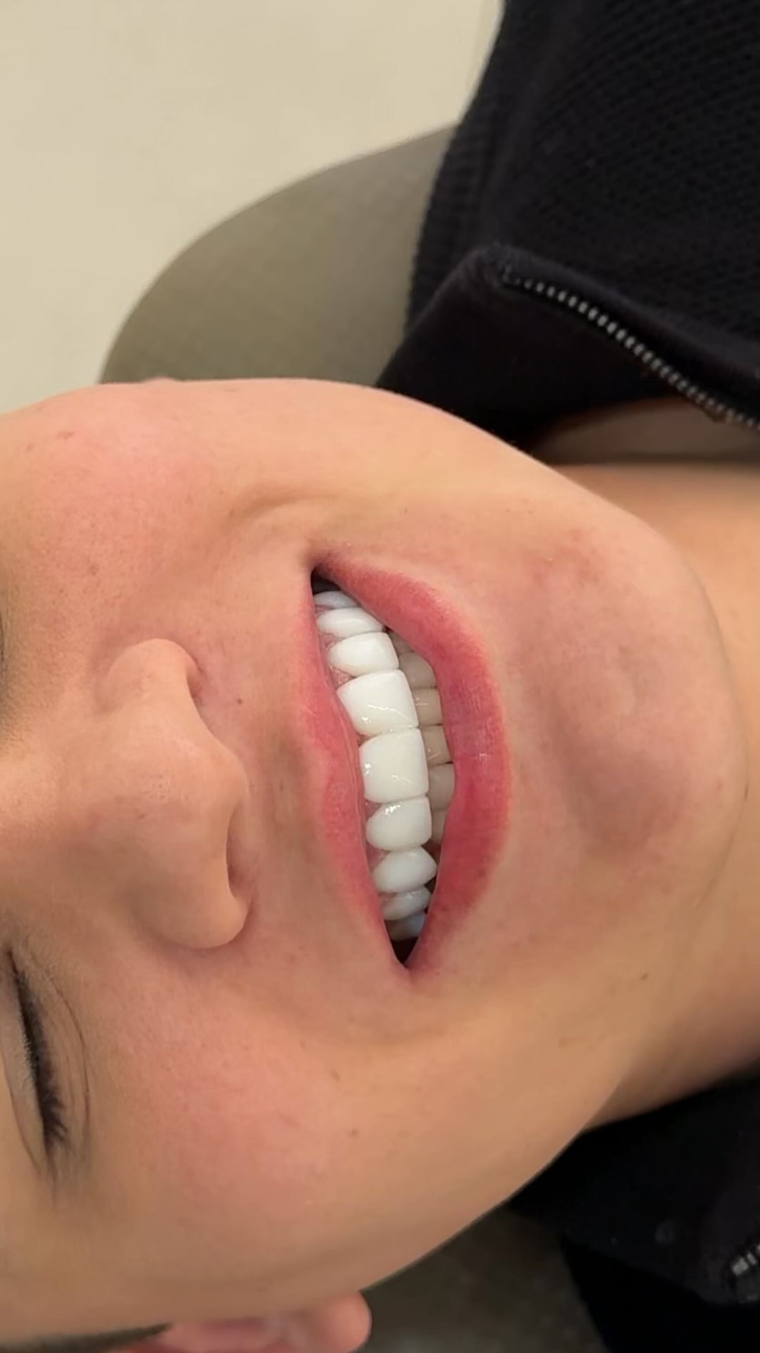 Sorriso finalizado com lentes em resina