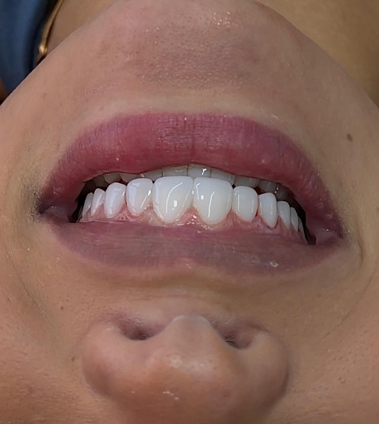 Sorriso harmônico após tratamento estético