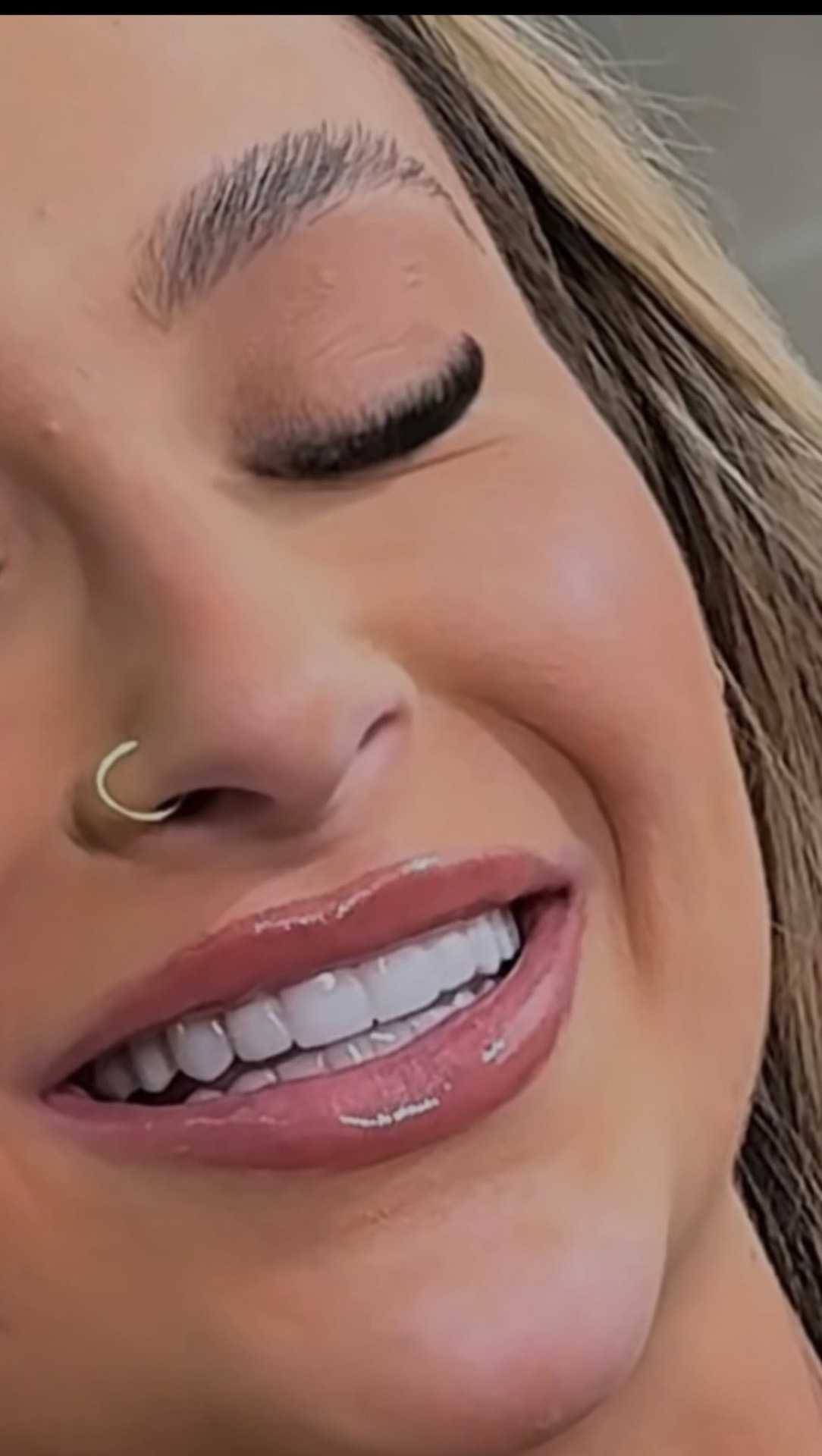 Paciente sorrindo após estética do sorriso