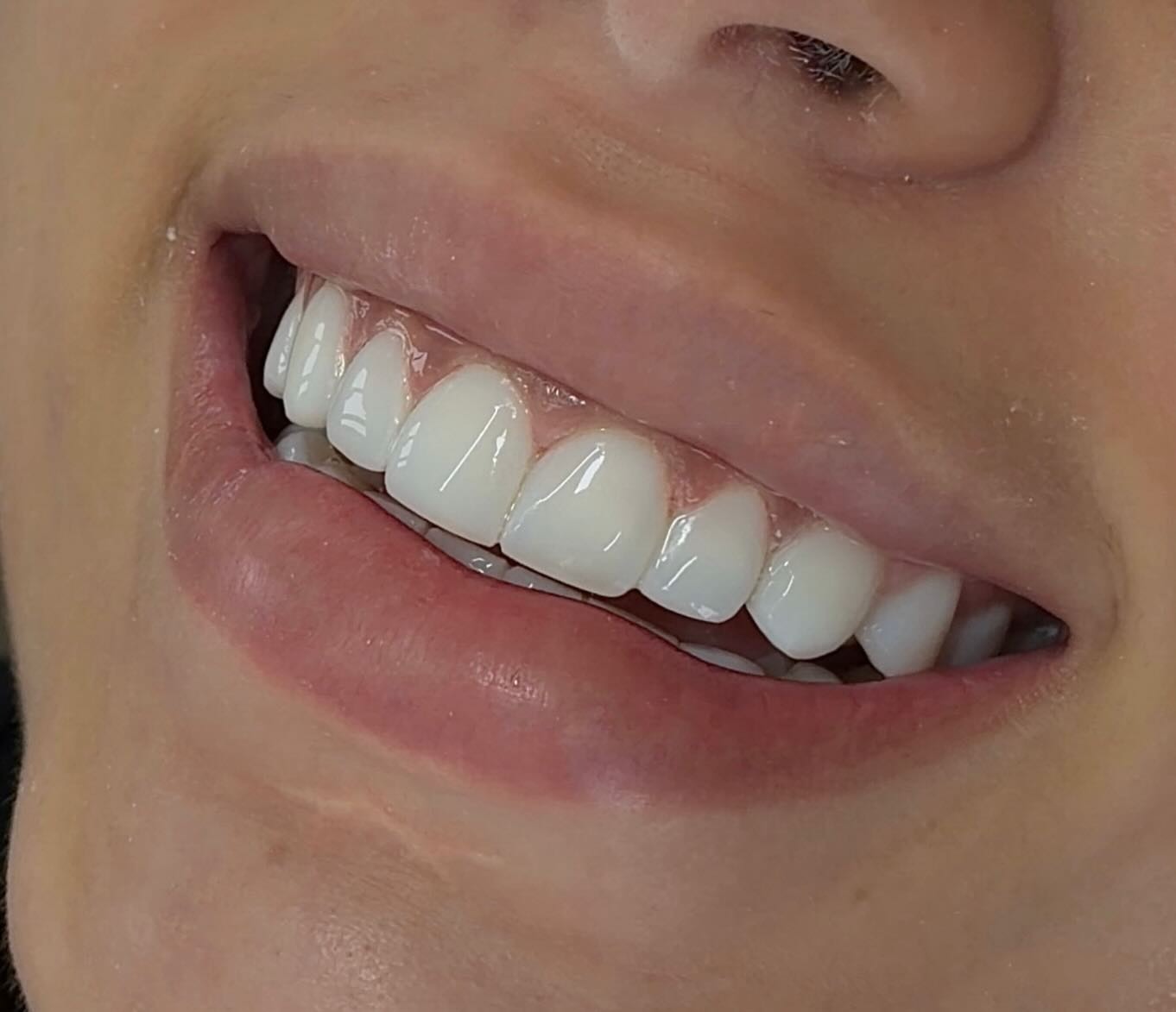 Close-up de dentes após lentes em resina